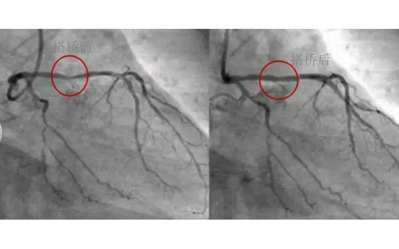 深圳市模具廠對心臟支架的關(guān)注，國產(chǎn)化的道路有多長？